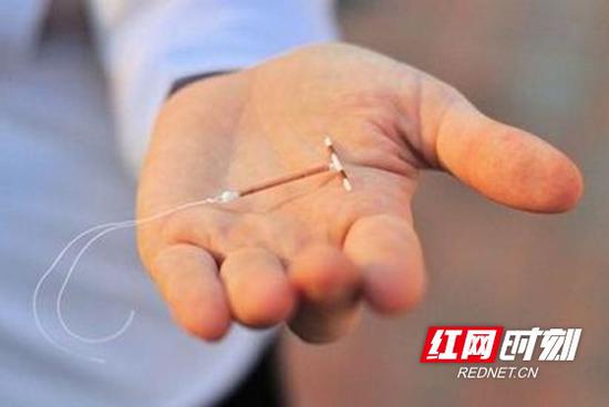 最新节育环图片展示及其步骤指南
