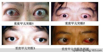 小明战胜甲亢的奇妙旅程,最新治疗与友情的力量