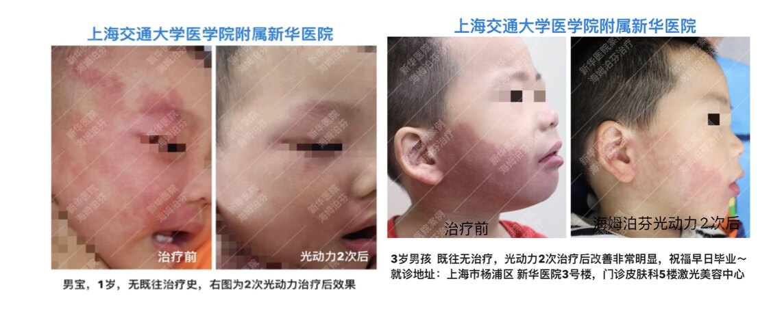 鲜红斑痣最新疗法详解,创新论述引领治疗新方向